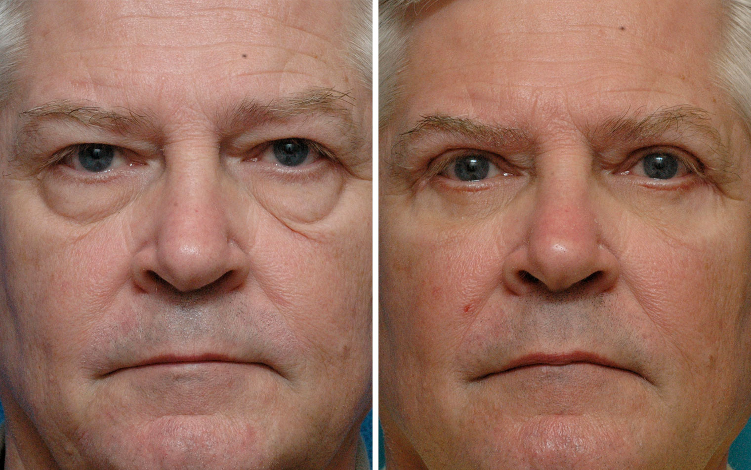 Before After 3